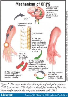 Mechanism of CRPS